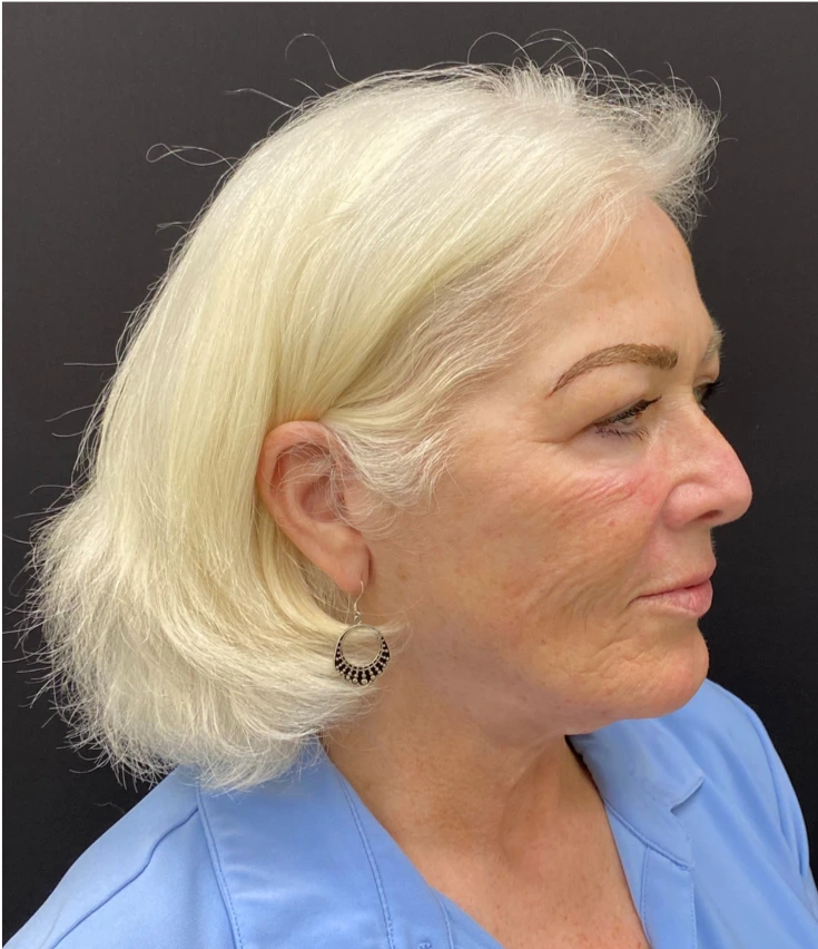 Facelift-Case--8874 | After Facelift 2