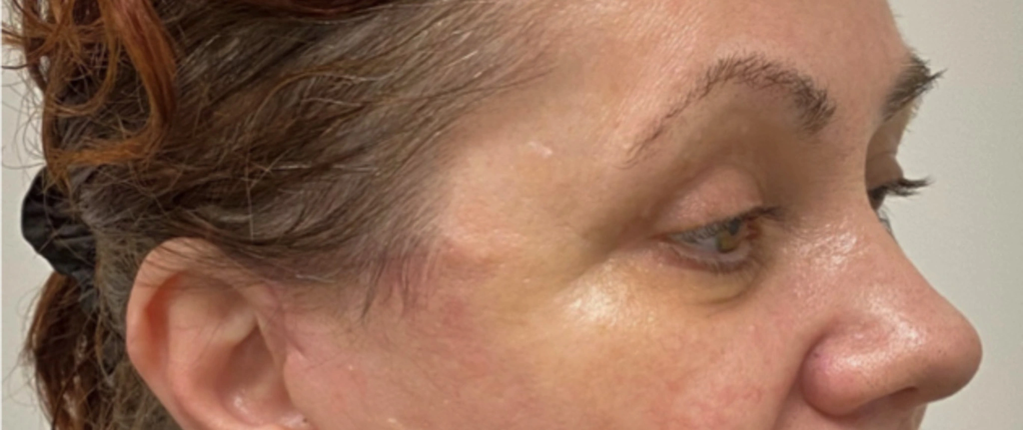 Quad-Blepharoplasty-Case--1851 | After Eyelid Surgery 3