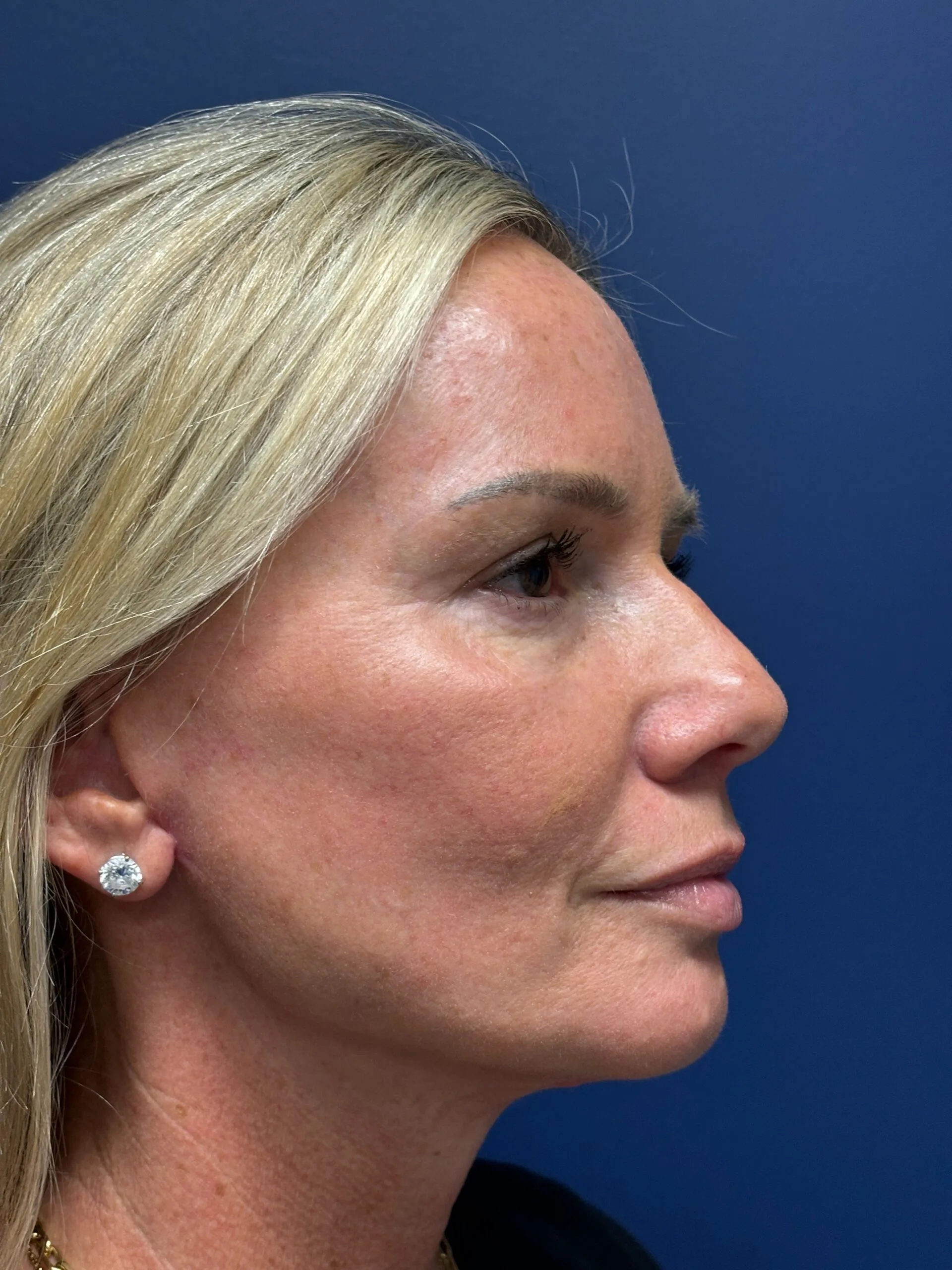 Quad-Blepharoplasty-Case--4265 | After Eyelid Surgery 3