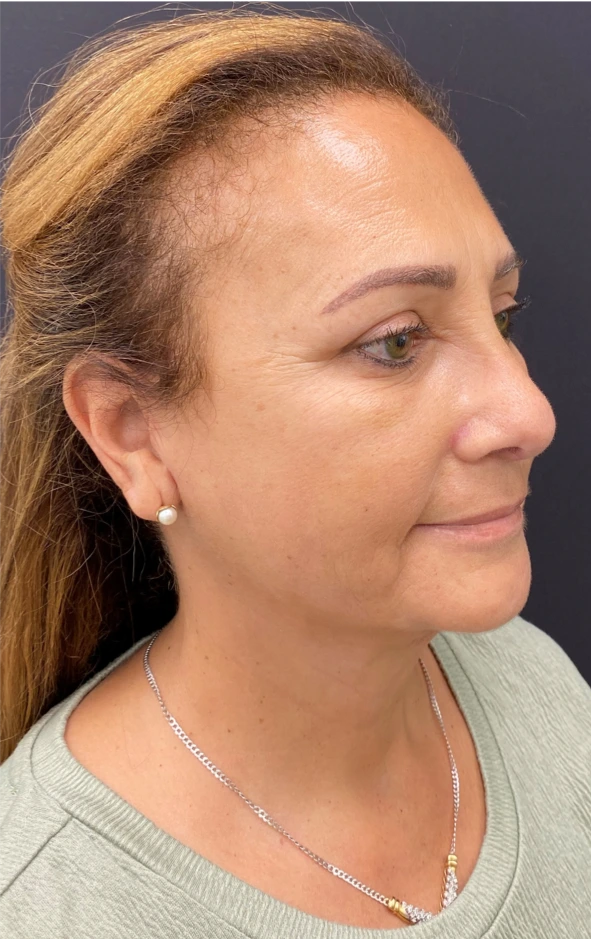 Facelift-Case--6496 | After Facelift 3