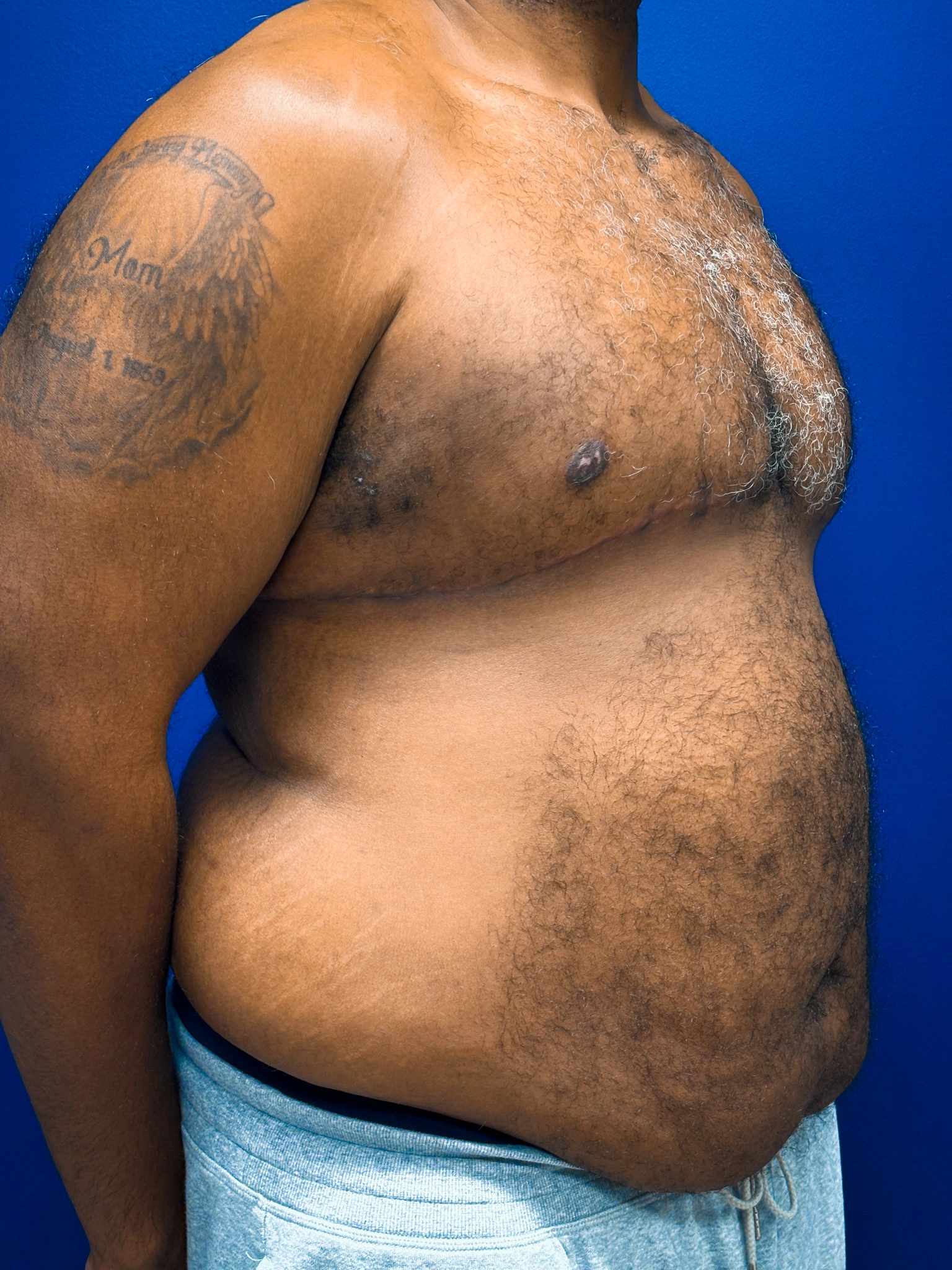 Gynecomastia-Case--4473 | After Gynecomastia / Male Breast Reduction 4