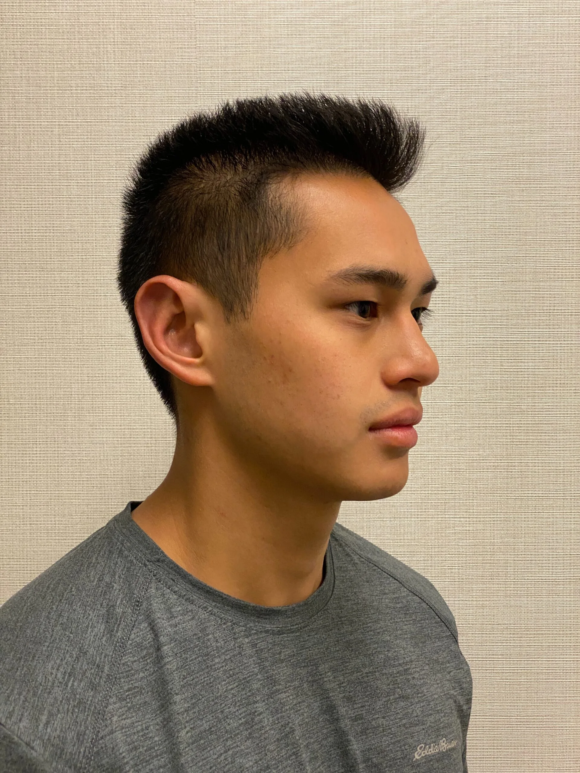 Otoplasty-Case--2681 | After Otoplasty 5