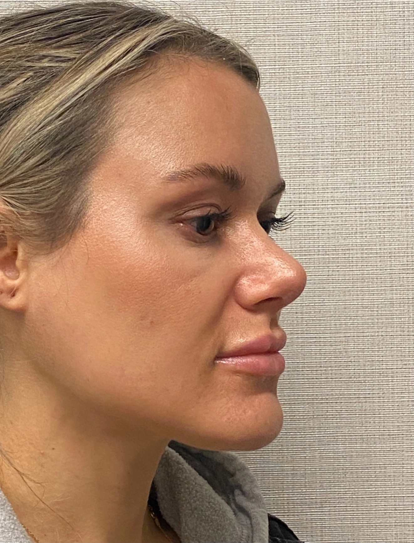 Rhinoplasty-Case--4972 | After Rhinoplasty 6