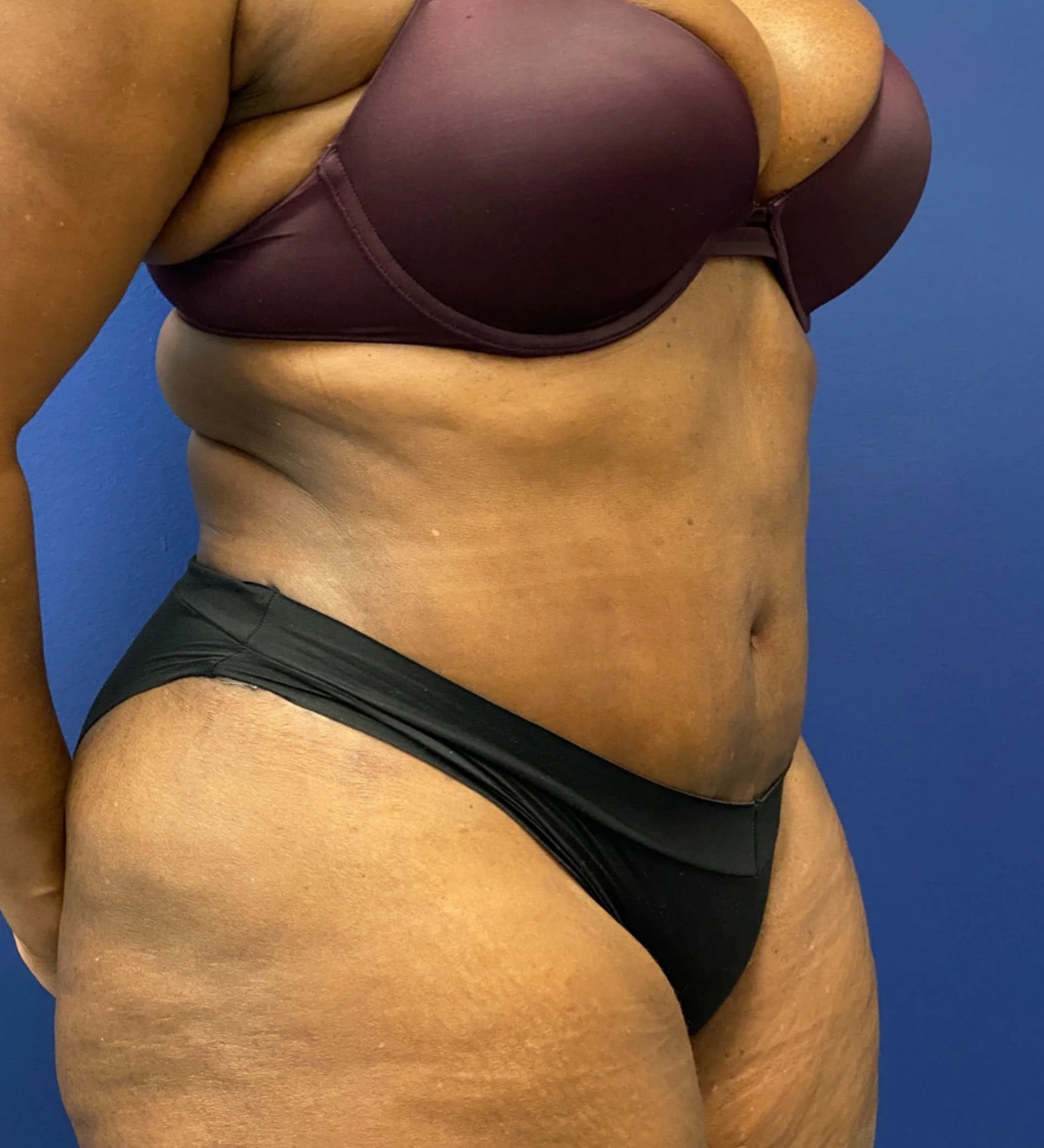 Abdominoplasty-Case--4427 | After Tummy Tuck 4