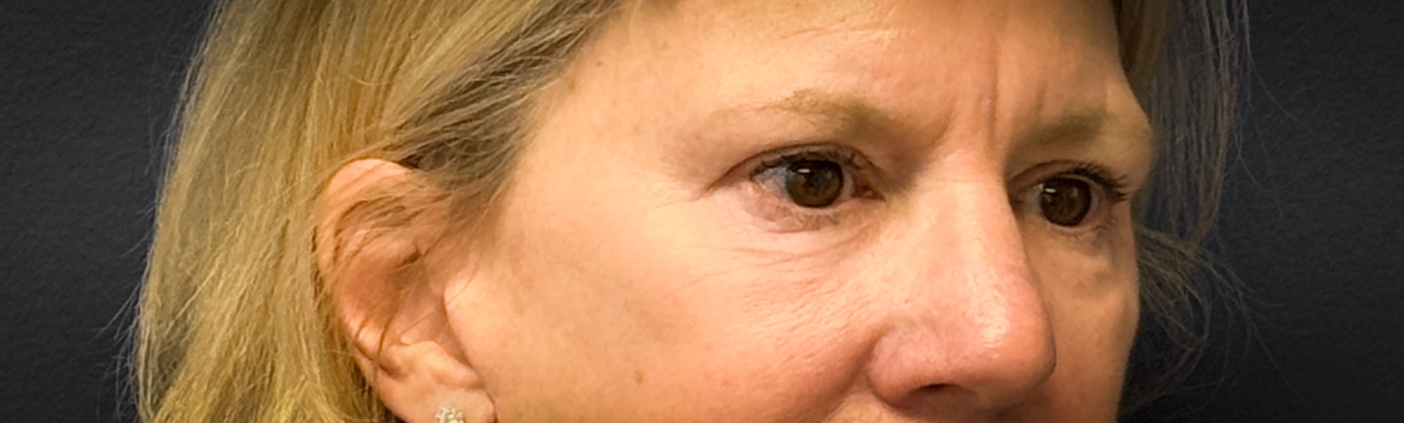 Blepharoplasty-Case--2653 | After Eyelid Surgery 3