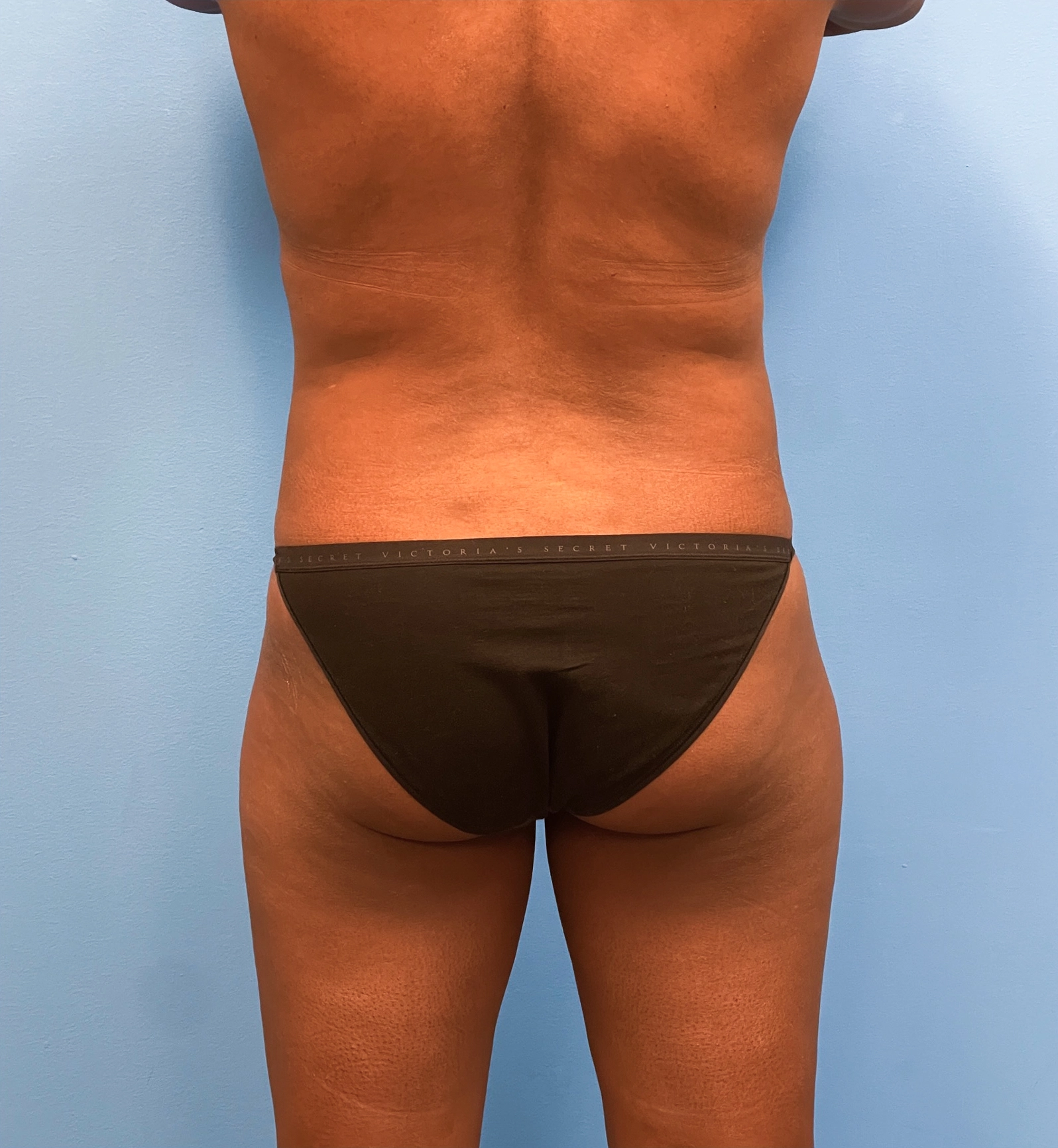 Abdominoplasty-Case--28134 | Before Tummy Tuck 4