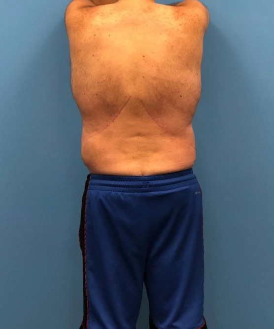 Back profile of patient after body lift procedure