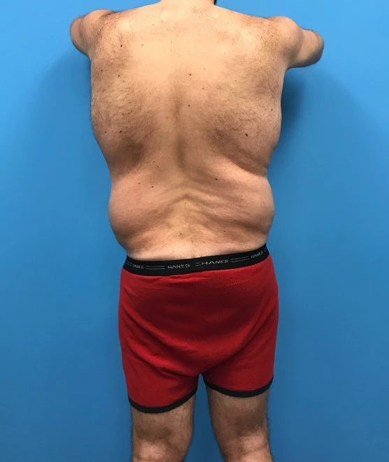 Back profile of patient before body lift procedure