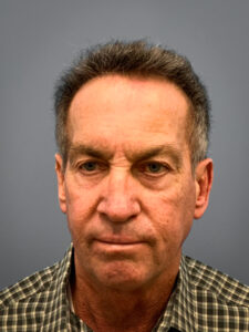 Before Facelift, Rhinoplasty, Blepharoplasty (Front)