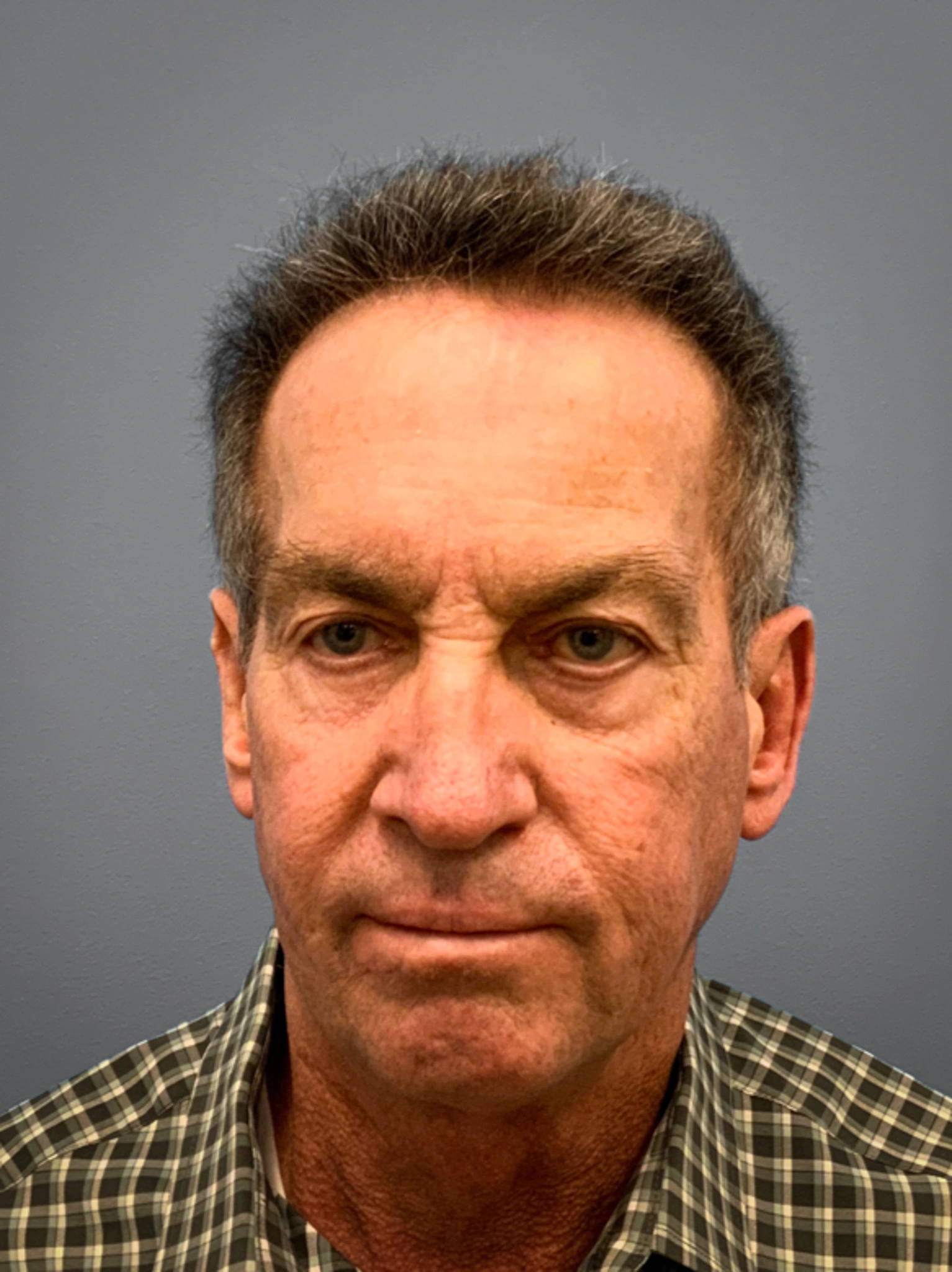 Before Facelift, Rhinoplasty, Blepharoplasty (Front)