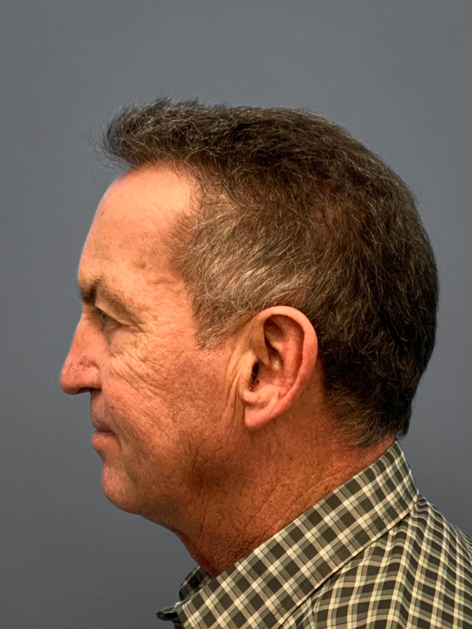 Before Facelift, Rhinoplasty, Blepharoplasty (Side)