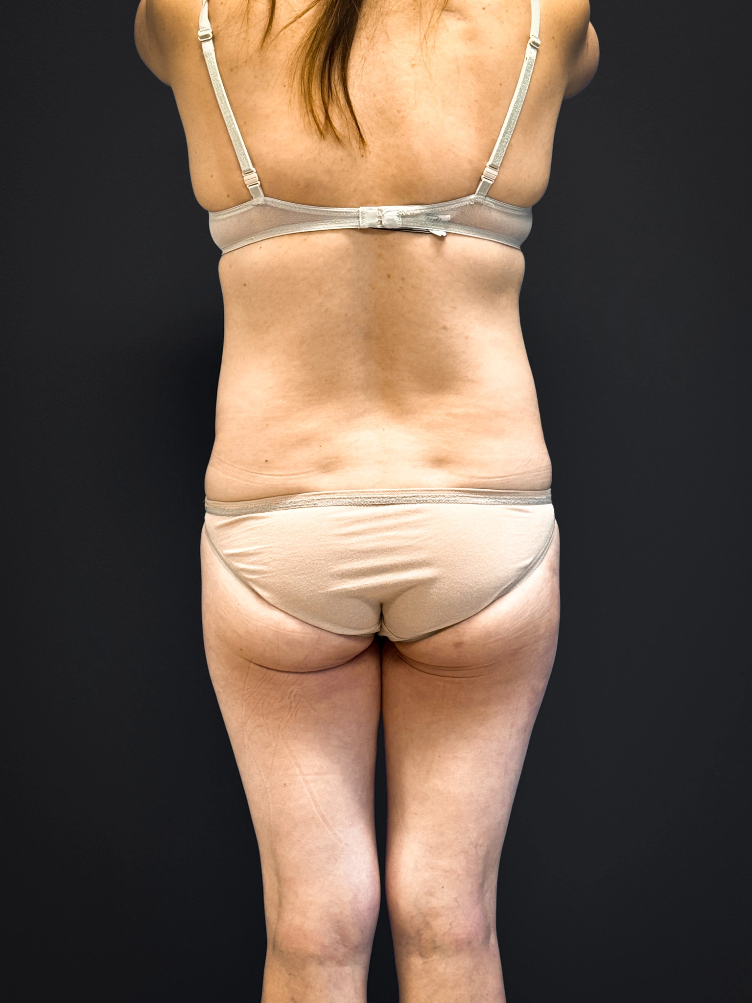 Tummy-Tuck-Case--5969 | Before Tummy Tuck 6