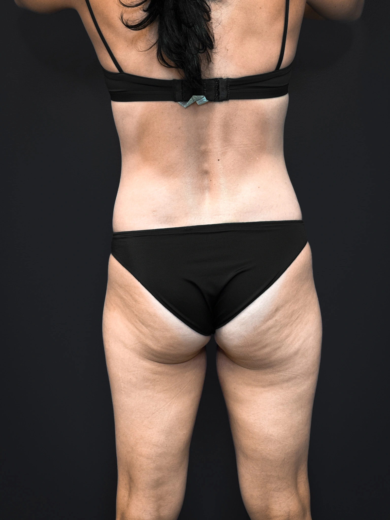 Tummy-Tuck-Case--2729 | Before Tummy Tuck 6