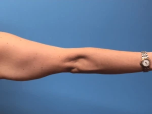 Brachioplasty-Case--276 | Before Arm Lift 2