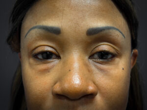 Facelift-Lower-Blepharoplasty-Case--6866 | Before Eyelid Surgery 2