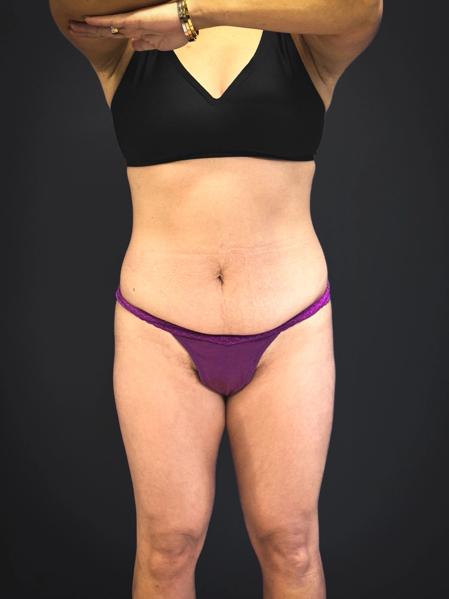 Tummy-Tuck-Case--3757 | Before Tummy Tuck 1