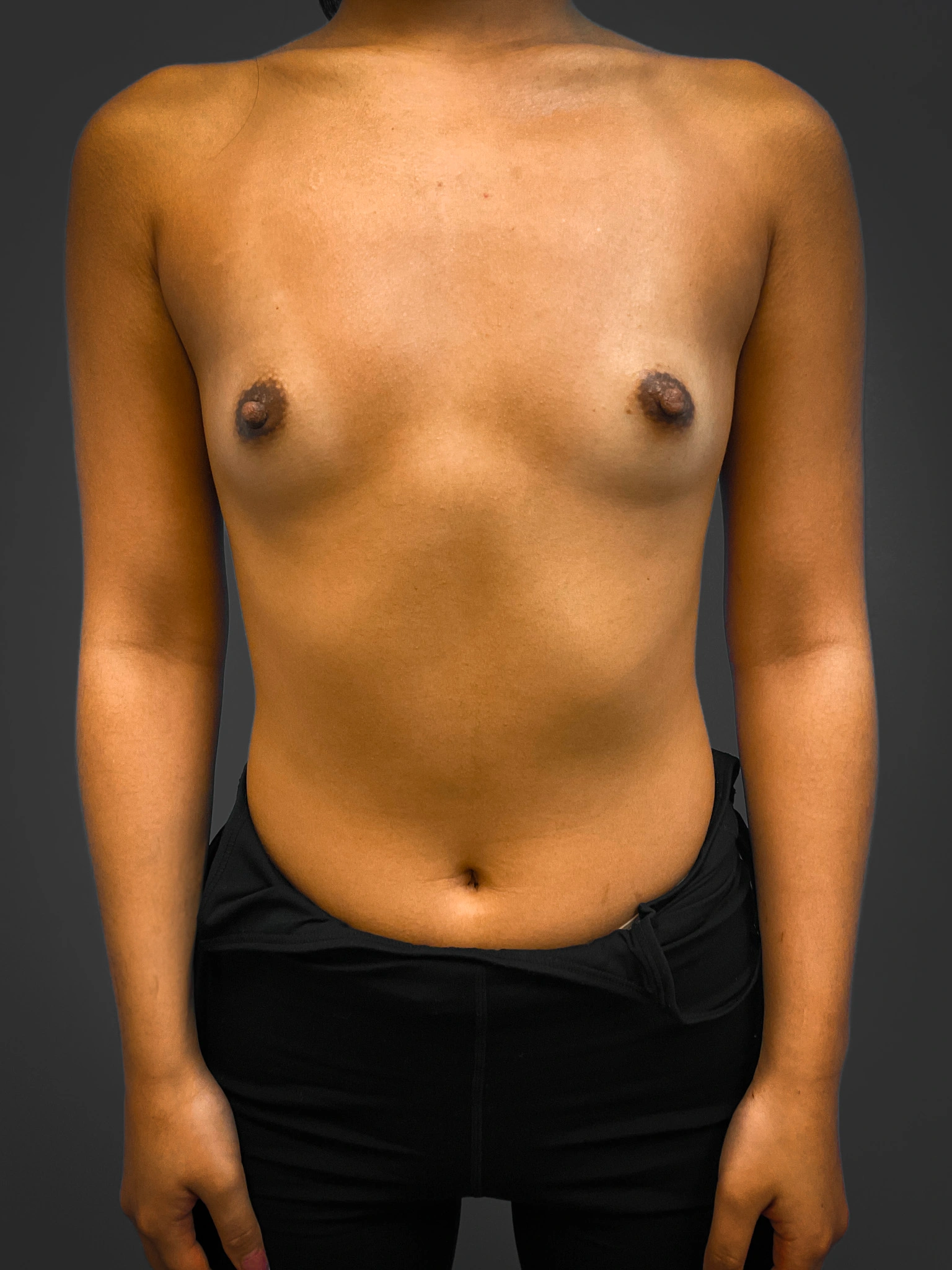 Breast-Augmentation-Case--4631 | Before Breast Augmentation 1