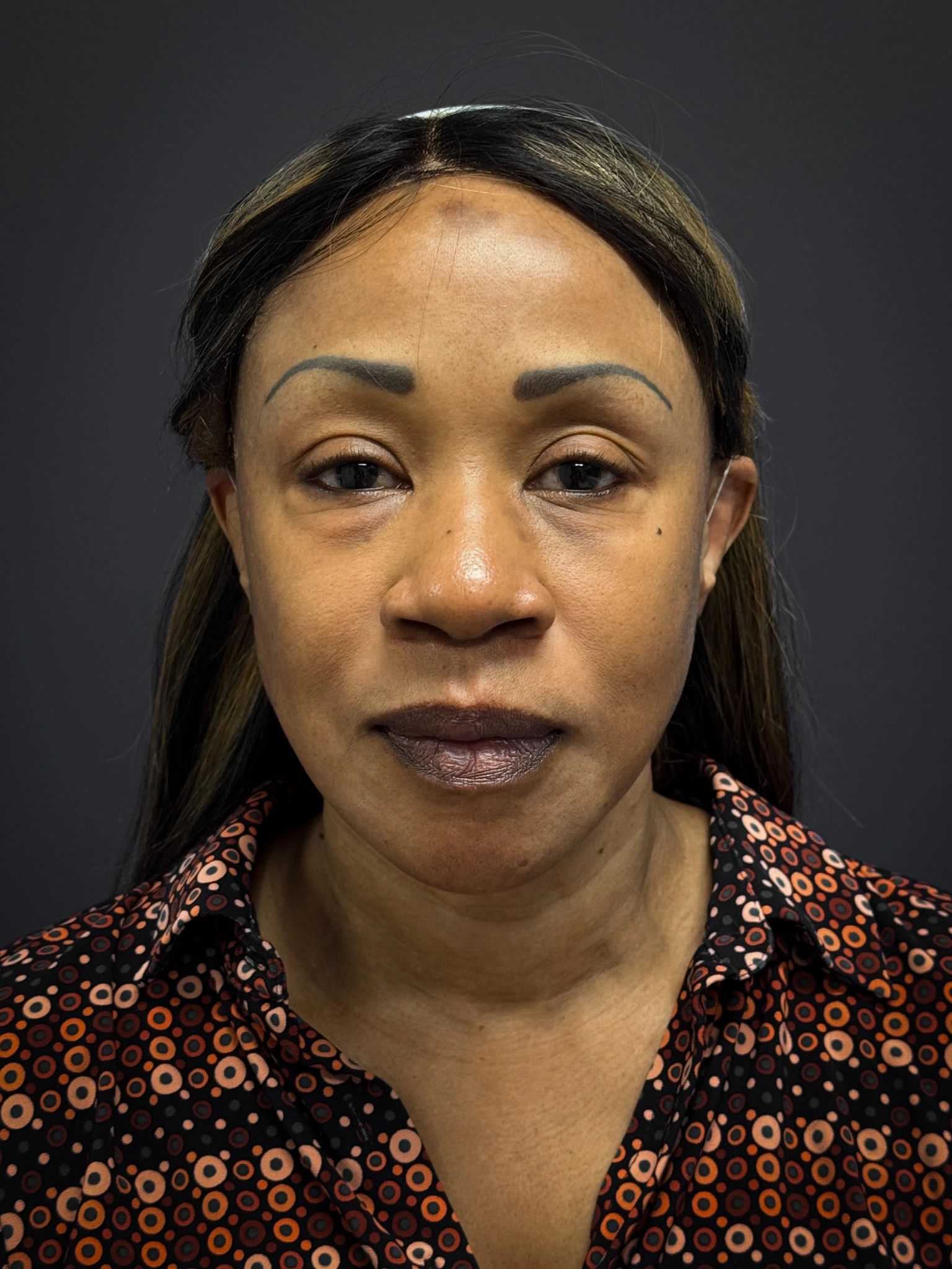 Facelift-Lower-Blepharoplasty-Case--6866 | Before Eyelid Surgery 1