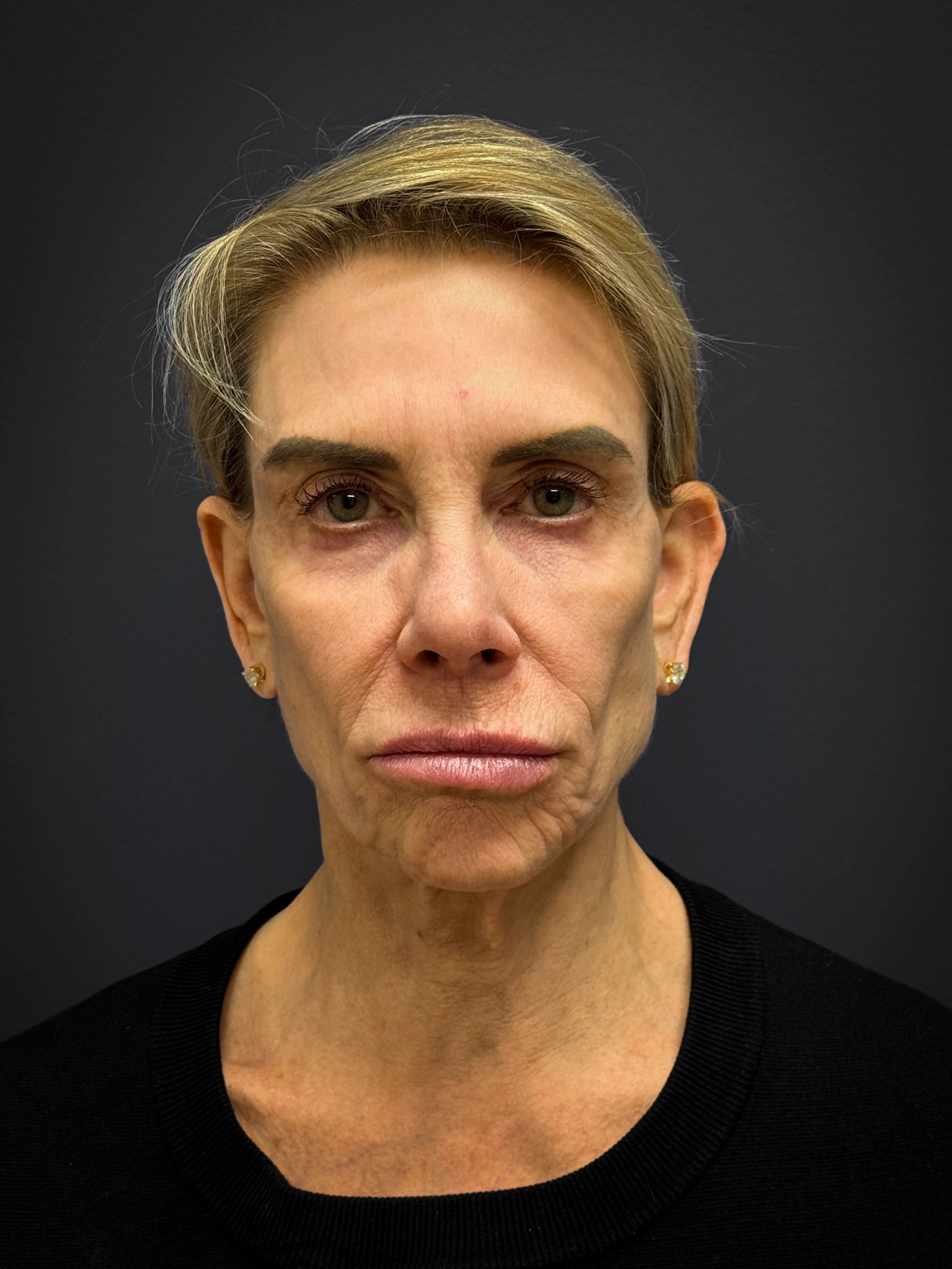 Facelift-Case--4219 | Before Facelift 1