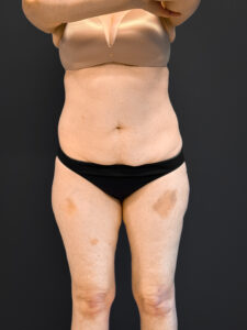 Tummy-Tuck-Case--7170 | Before Tummy Tuck 1