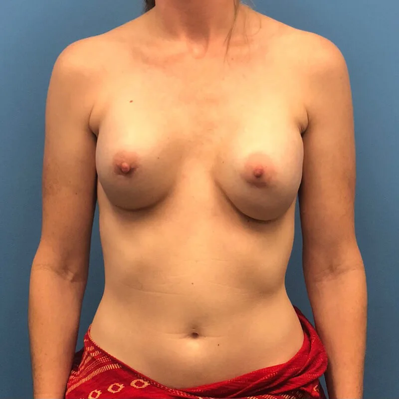 Revision-Augmentation-Case--235 | Before Revision Augmentation 1