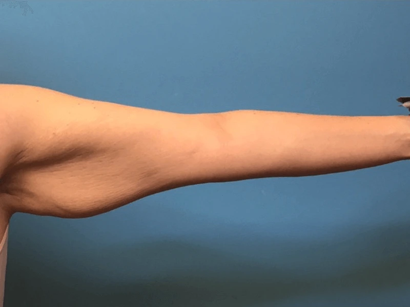 Brachioplasty-Case--276 | Before Arm Lift 4
