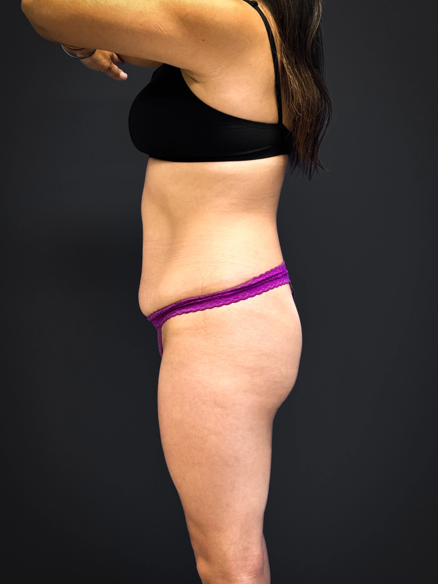 Tummy-Tuck-Case--3757 | Before Tummy Tuck 5