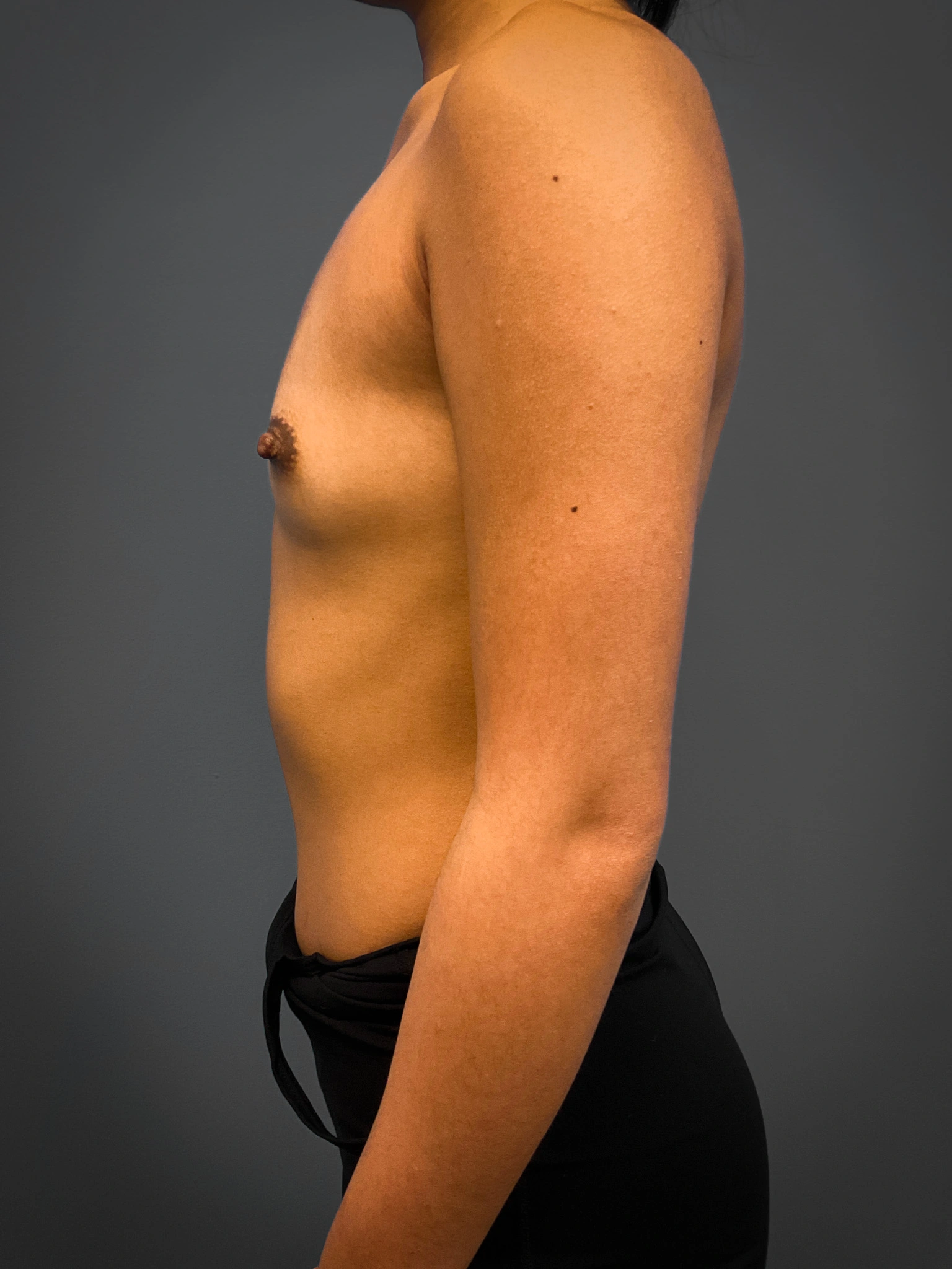 Breast-Augmentation-Case--4631 | Before Breast Augmentation 2
