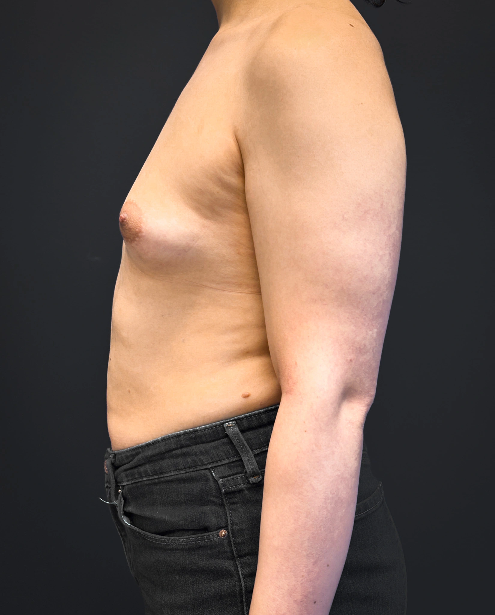 Left profile of patient before undergoing breast augmentation surgery