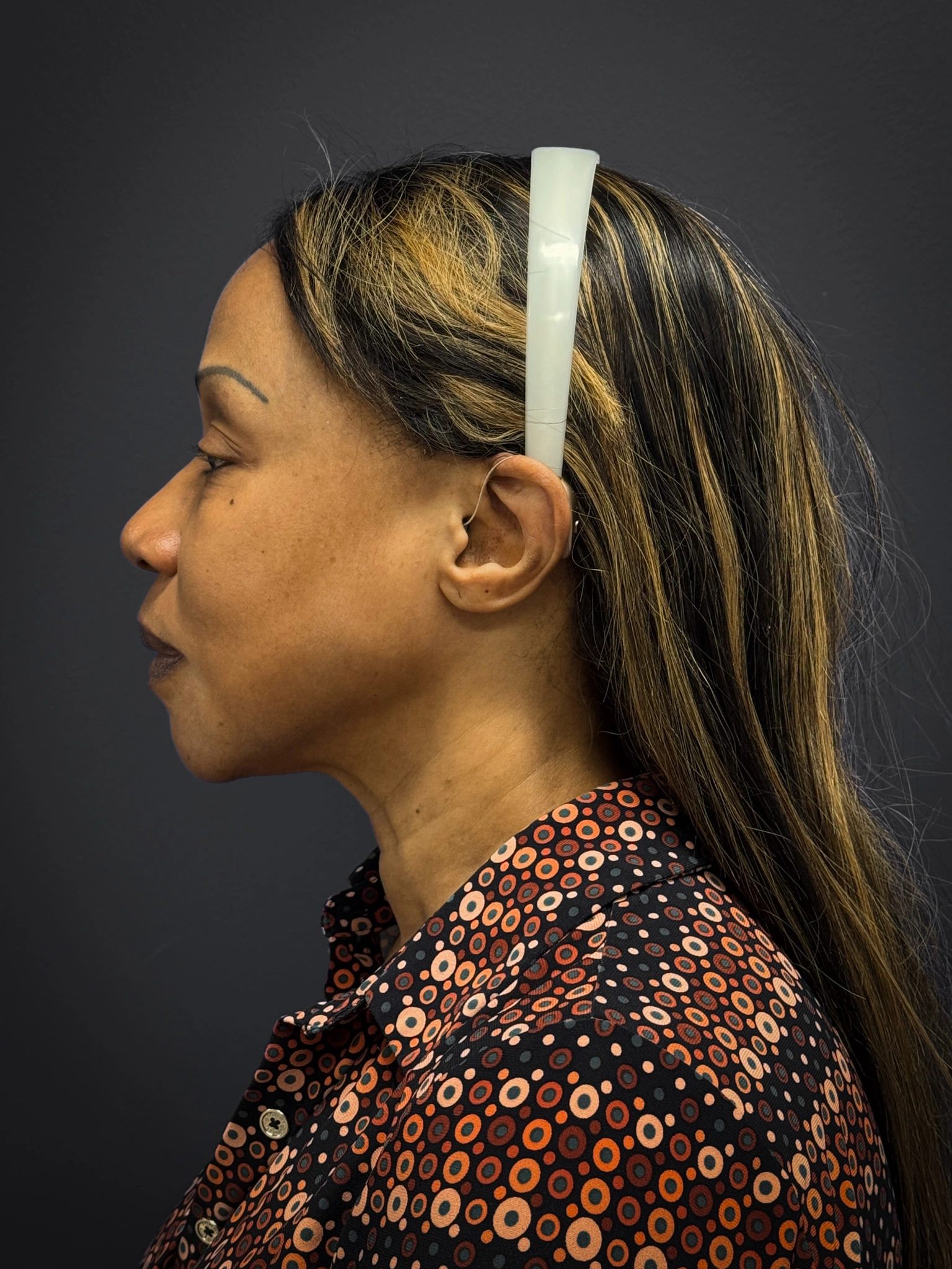 Facelift-Lower-Blepharoplasty-Case--6866 | Before Eyelid Surgery 3