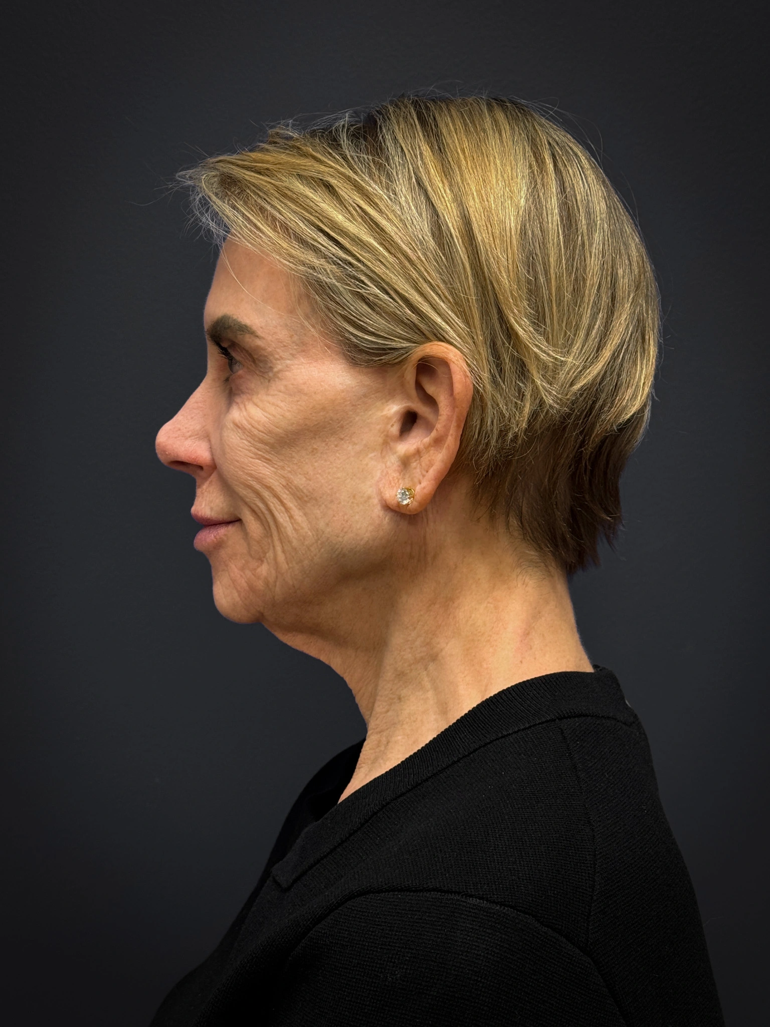 Facelift-Case--4219 | Before Facelift 4