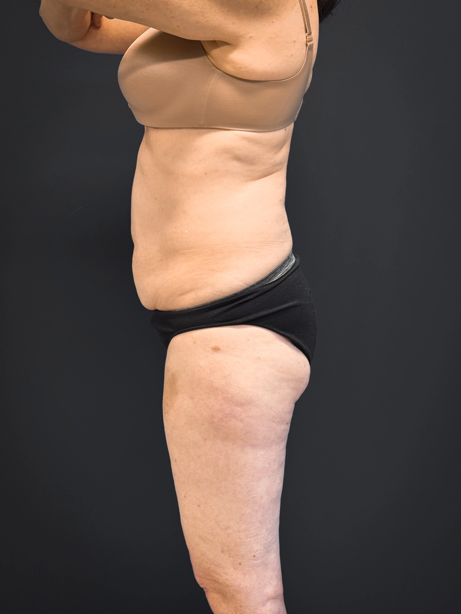 Tummy-Tuck-Case--7170 | Before Tummy Tuck 3