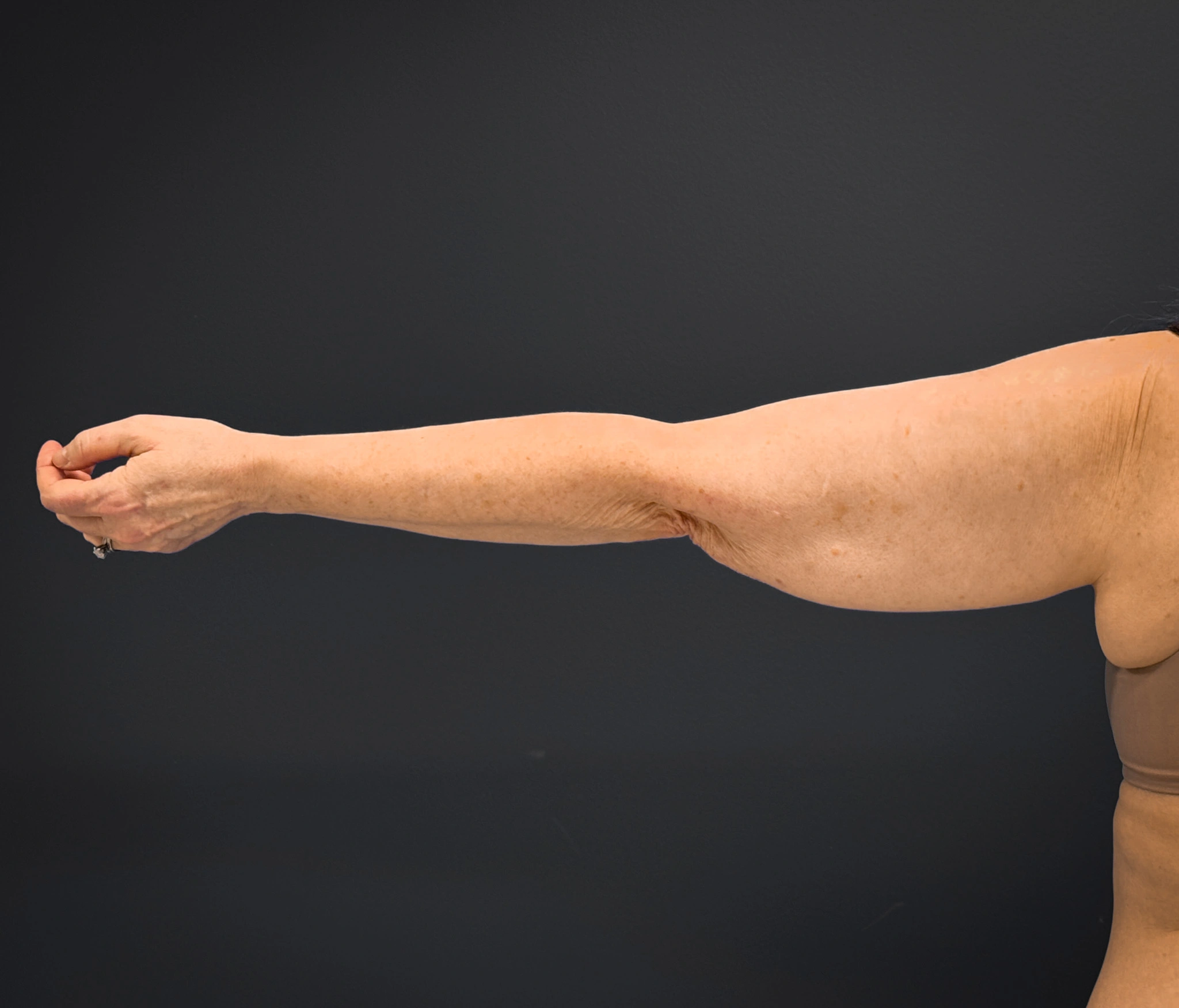 Brachioplasty-Case--3119 | Before Arm Lift 3