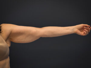 Brachioplasty-Case--3119 | Before Arm Lift 2