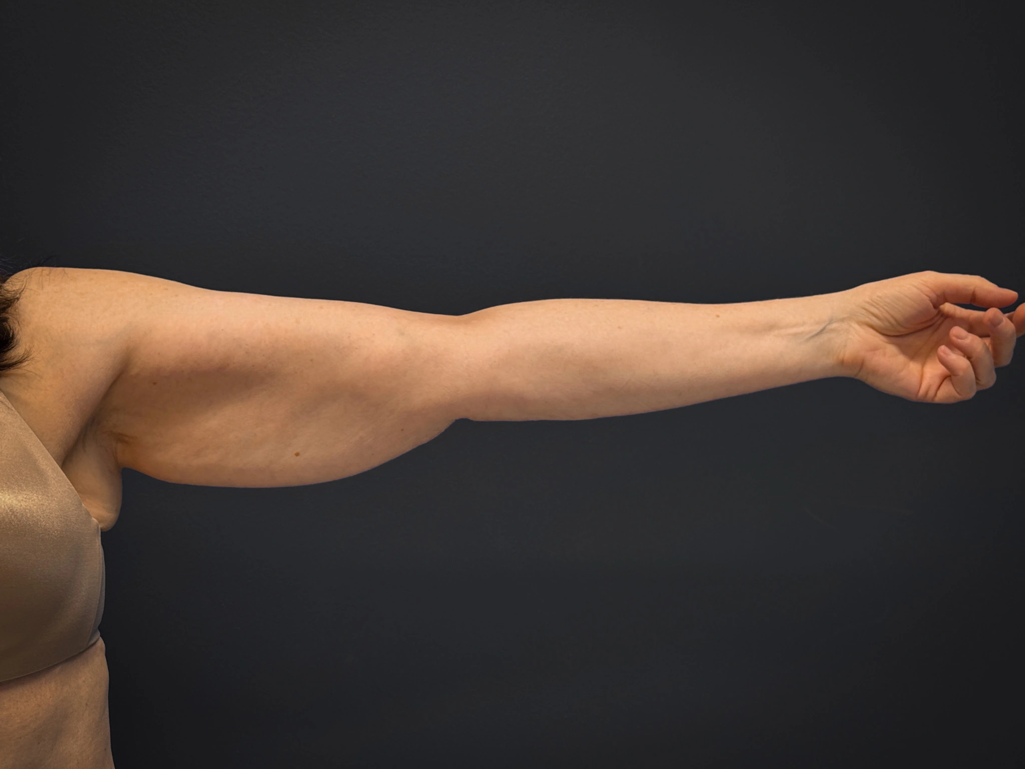 Brachioplasty-Case--3119 | Before Arm Lift 2