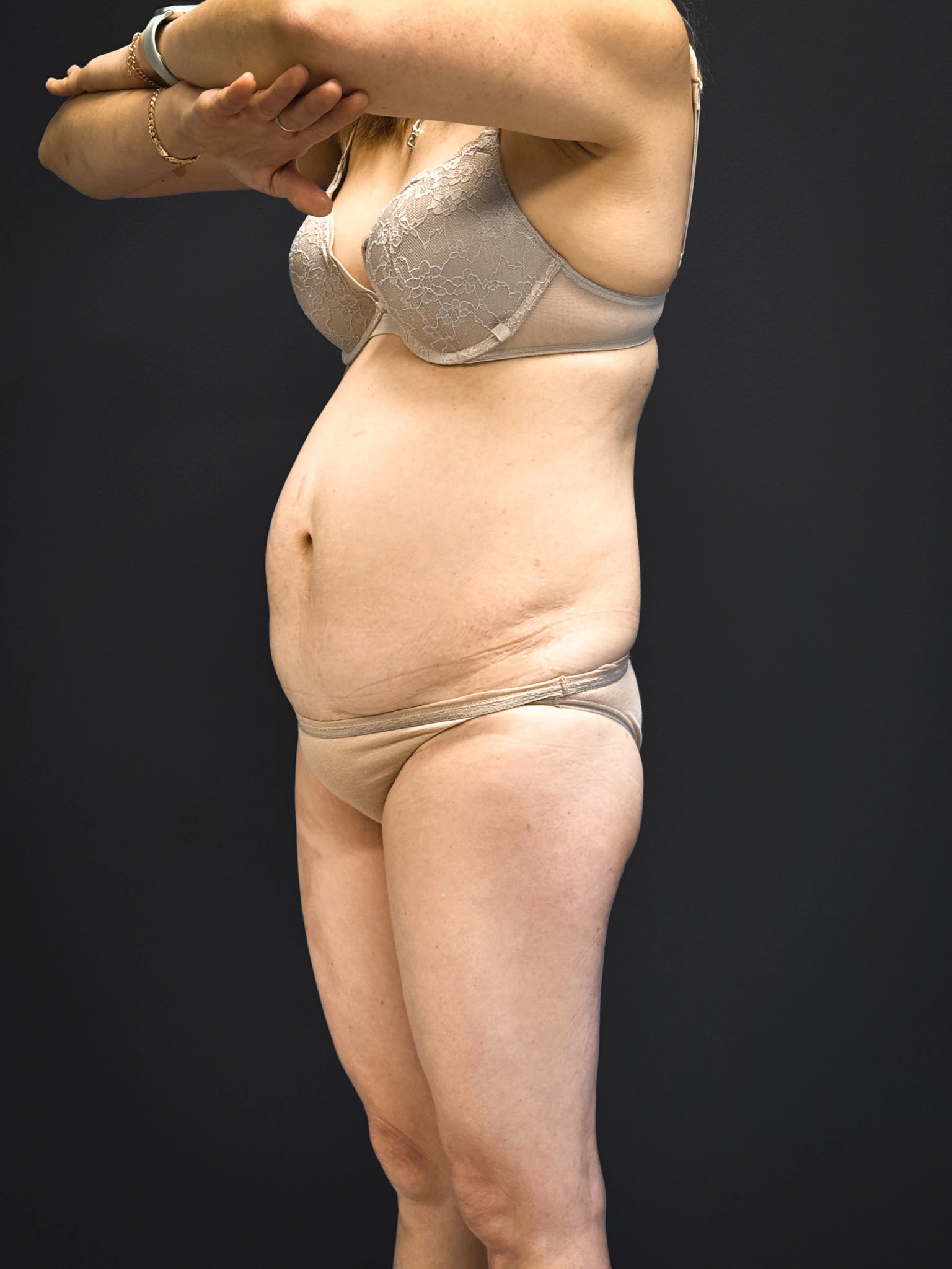 Tummy-Tuck-Case--5969 | Before Tummy Tuck 5