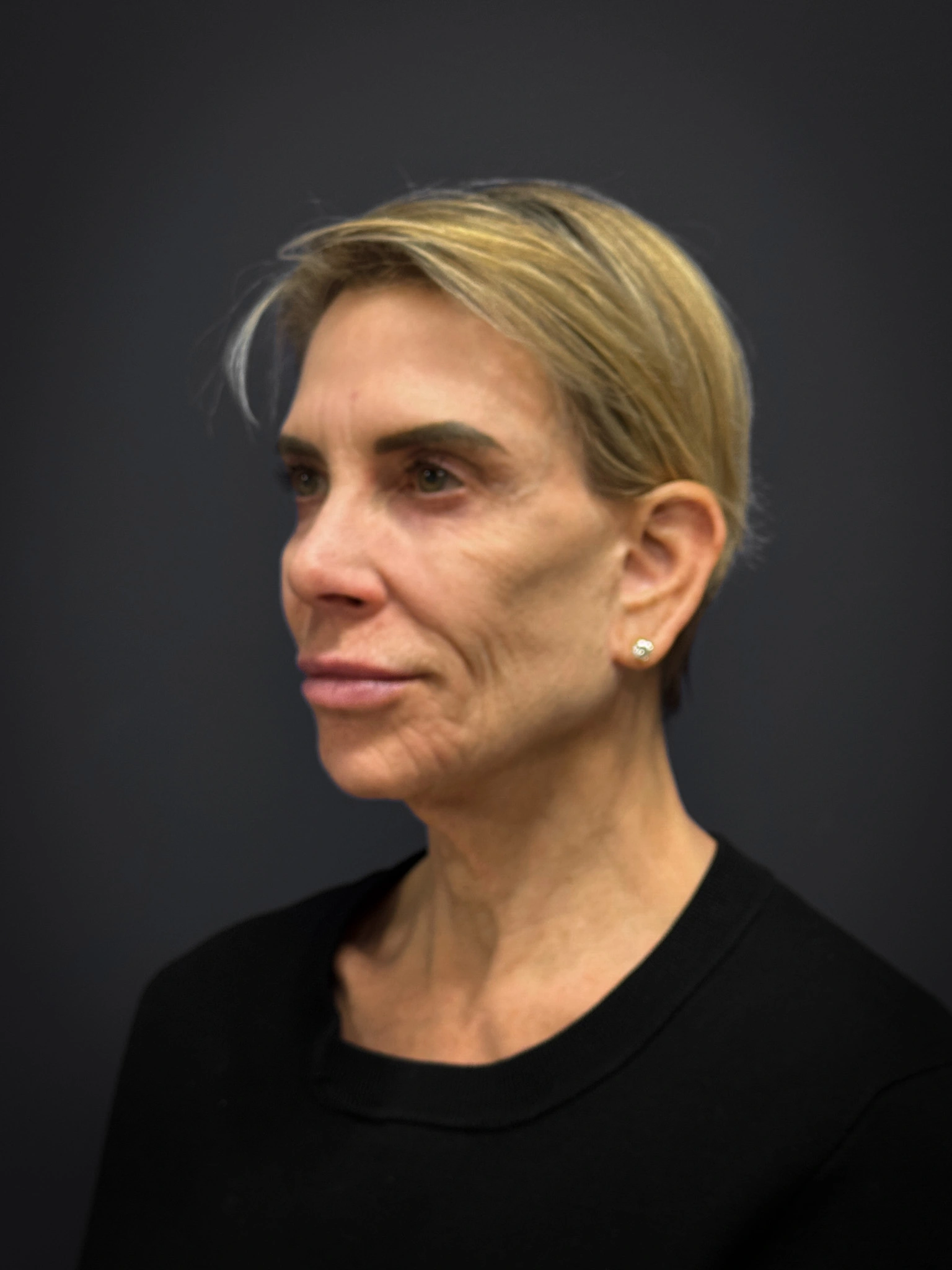 Facelift-Case--4219 | Before Facelift 5