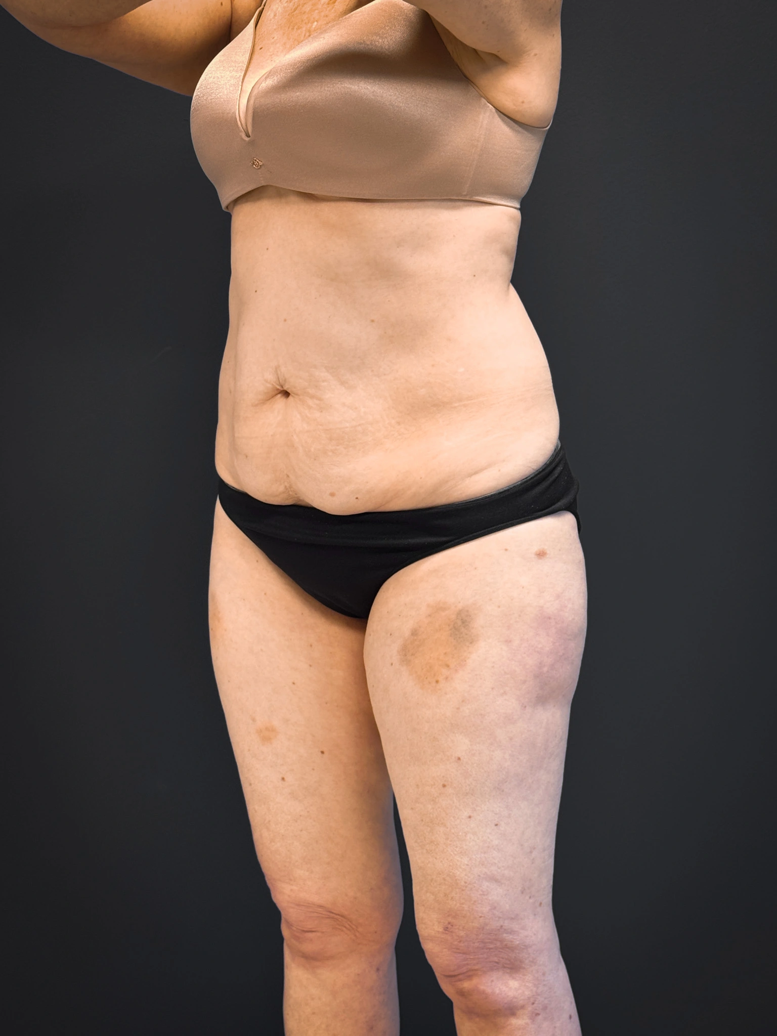 Tummy-Tuck-Case--7170 | Before Tummy Tuck 2