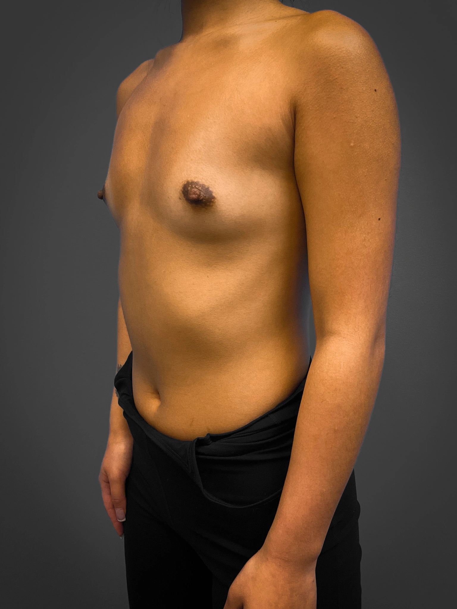 Breast-Augmentation-Case--4631 | Before Breast Augmentation 4