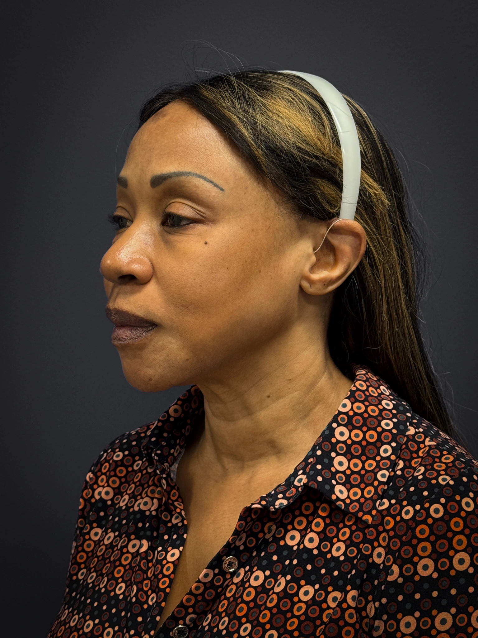 Facelift-Lower-Blepharoplasty-Case--6866 | Before Eyelid Surgery 5