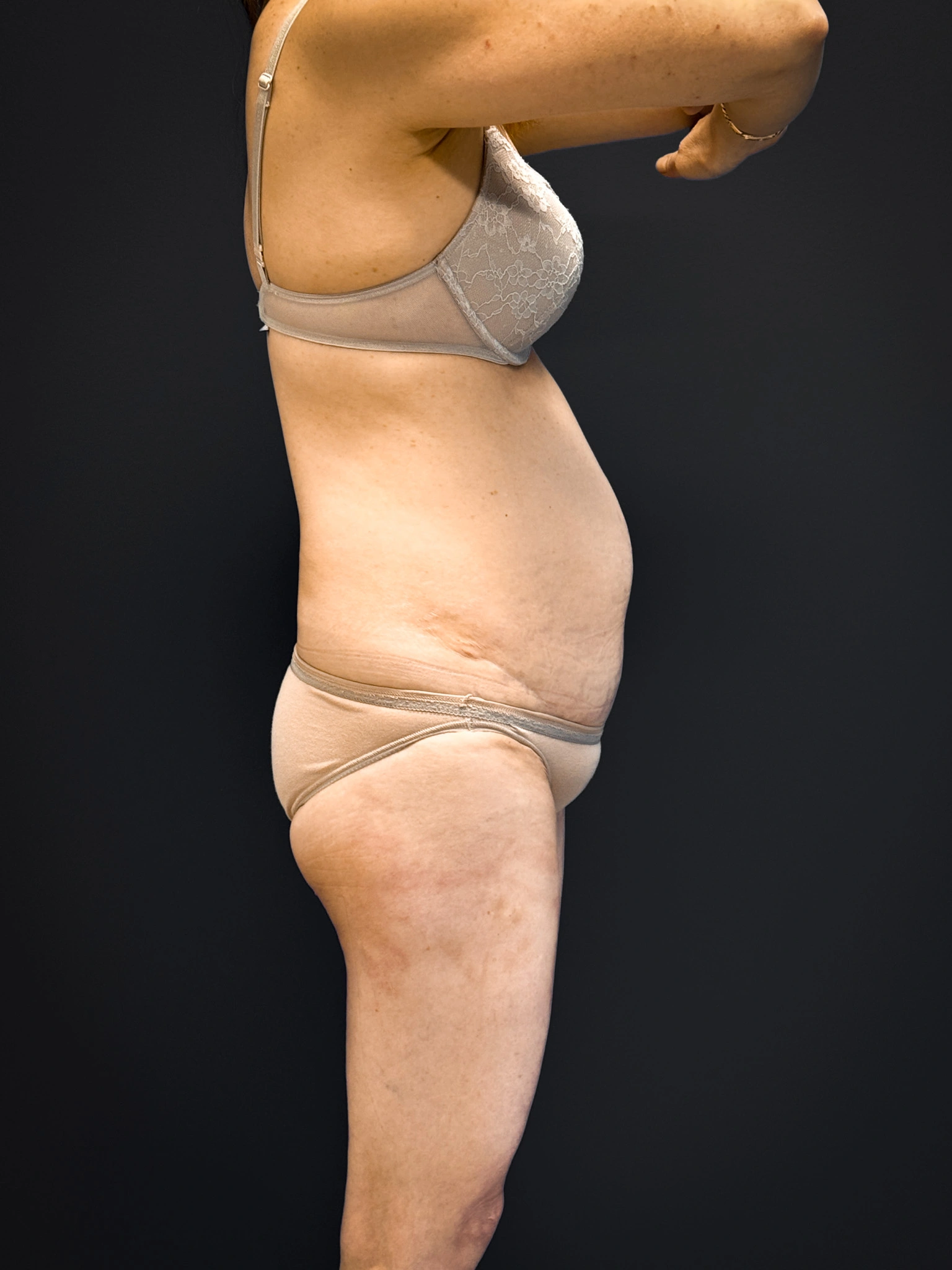 Tummy-Tuck-Case--5969 | Before Tummy Tuck 2