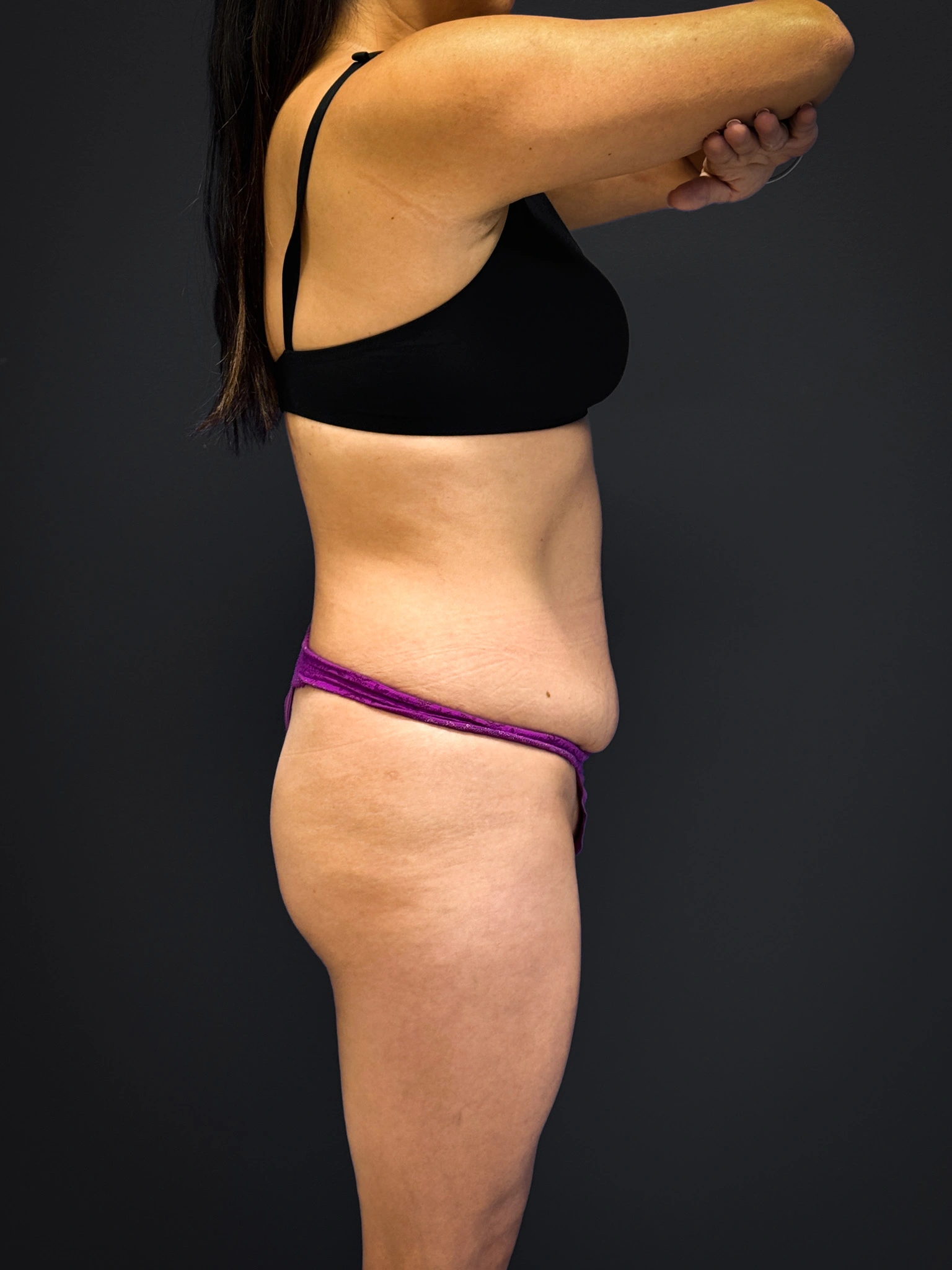 Tummy-Tuck-Case--3757 | Before Tummy Tuck 2