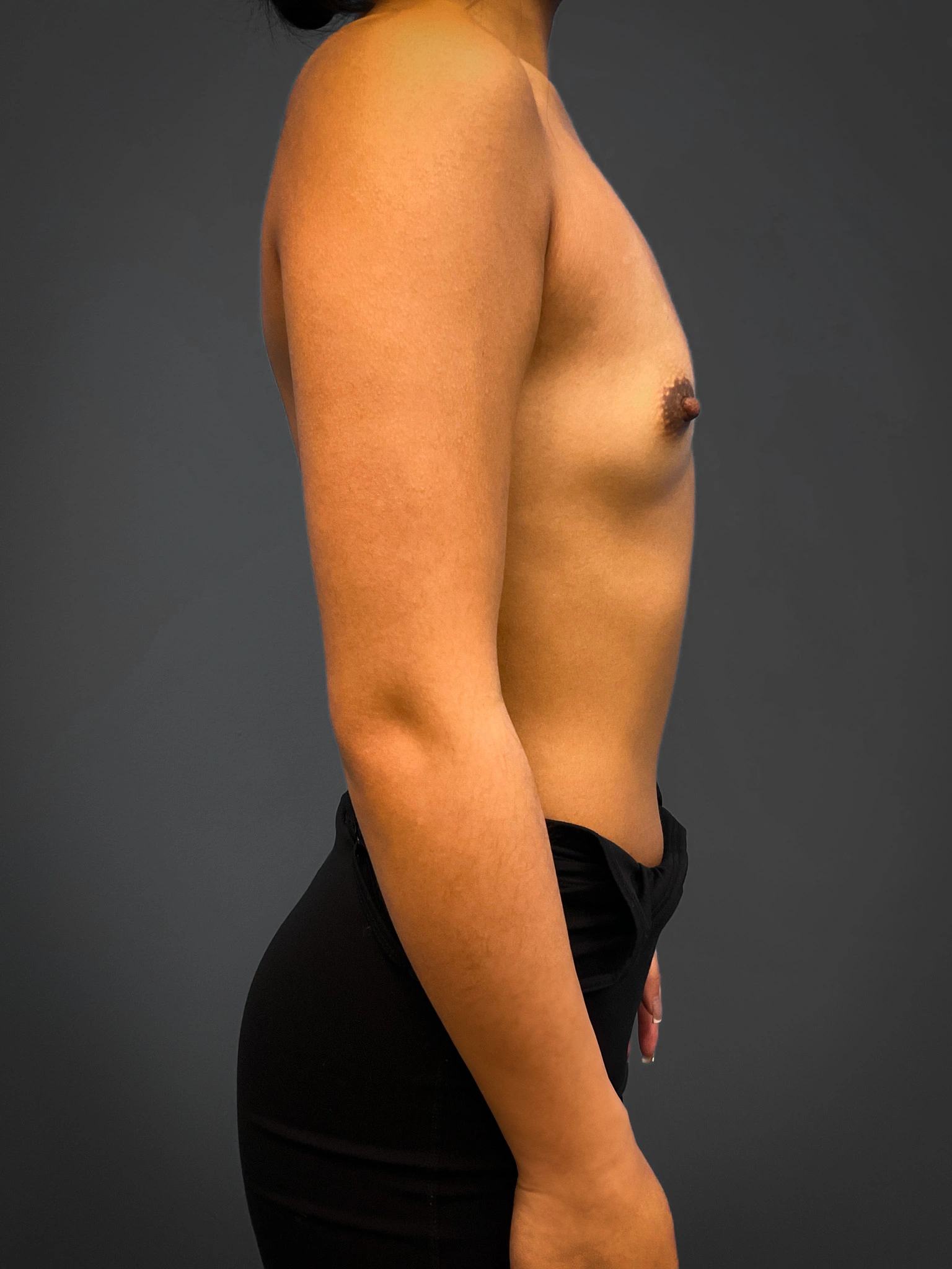 Breast-Augmentation-Case--4631 | Before Breast Augmentation 3