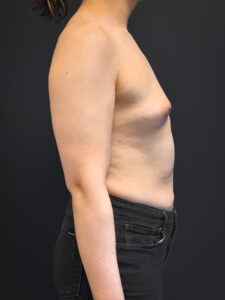 Right profile of patient before undergoing breast augmentation surgery