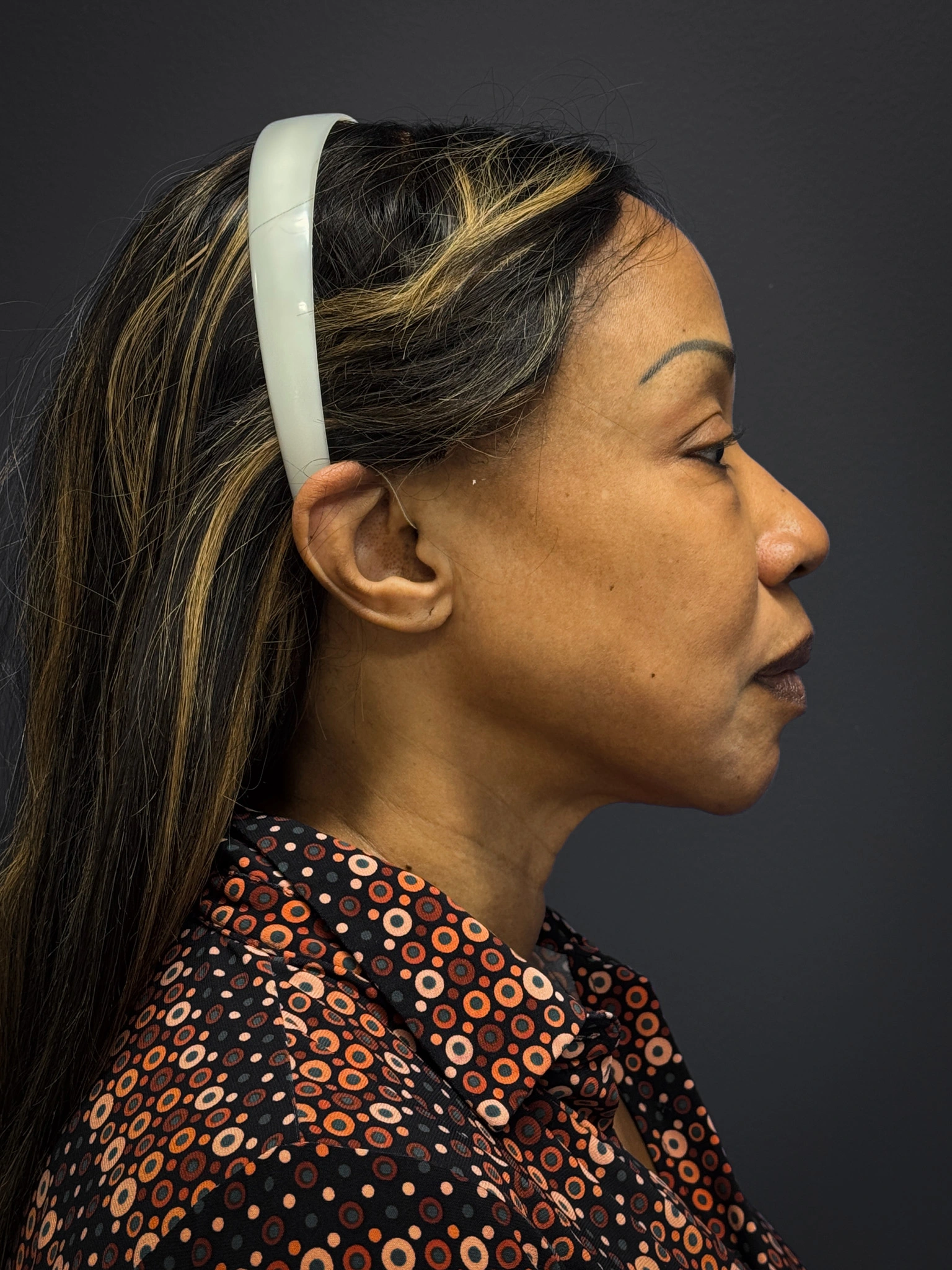 Facelift-Lower-Blepharoplasty-Case--6866 | Before Eyelid Surgery 4