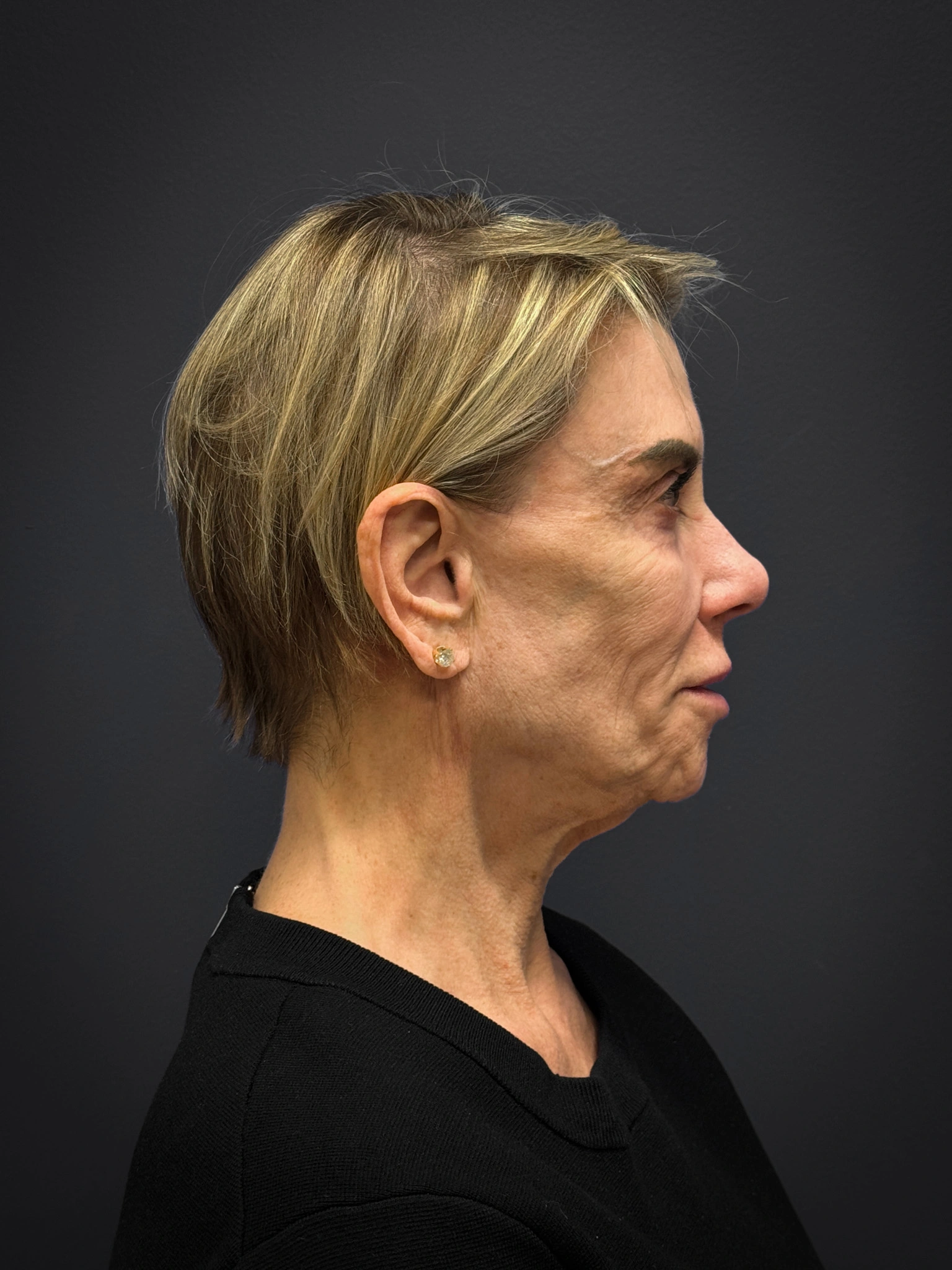 Facelift-Case--4219 | Before Facelift 2