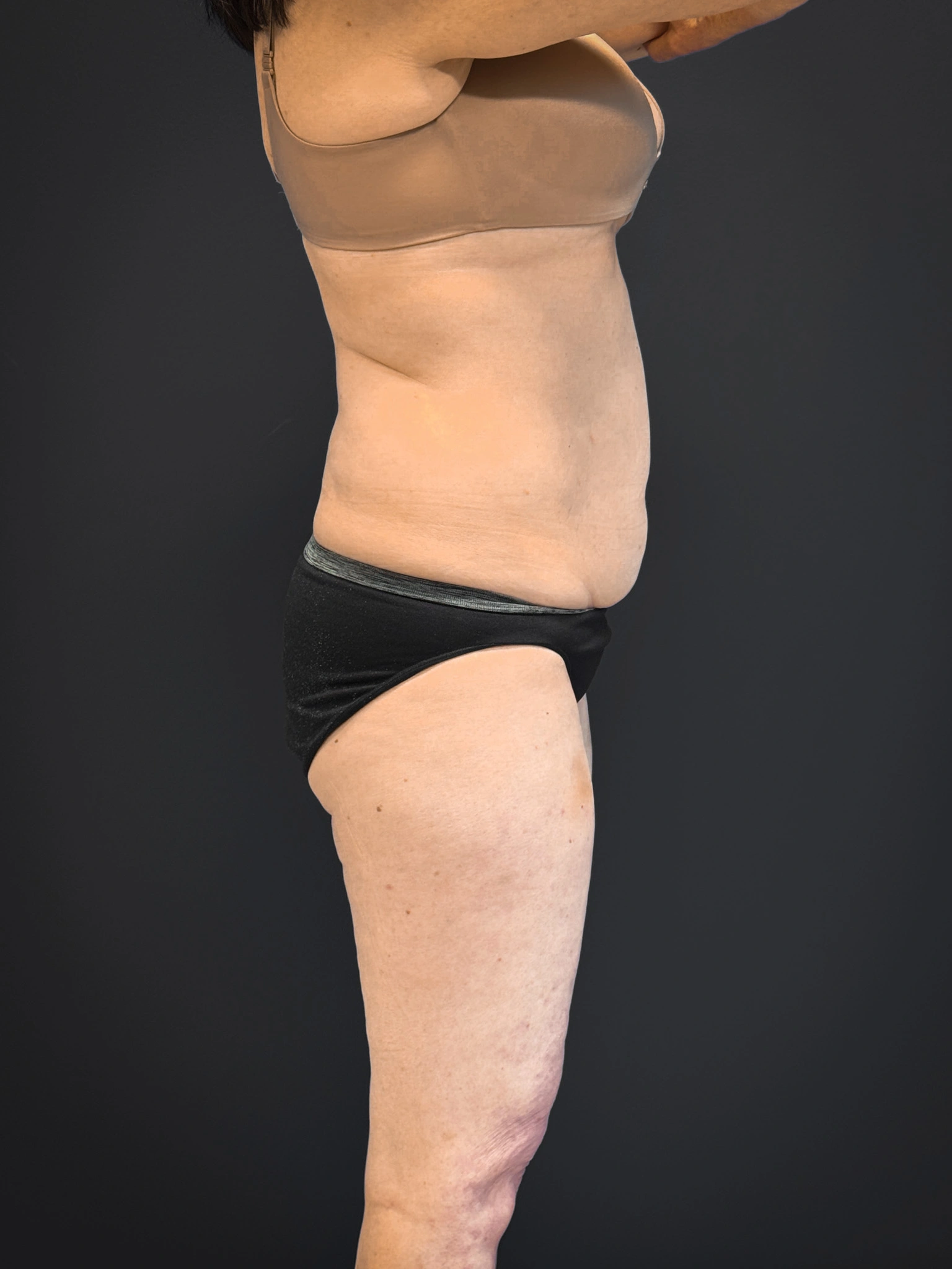 Tummy-Tuck-Case--7170 | Before Tummy Tuck 5