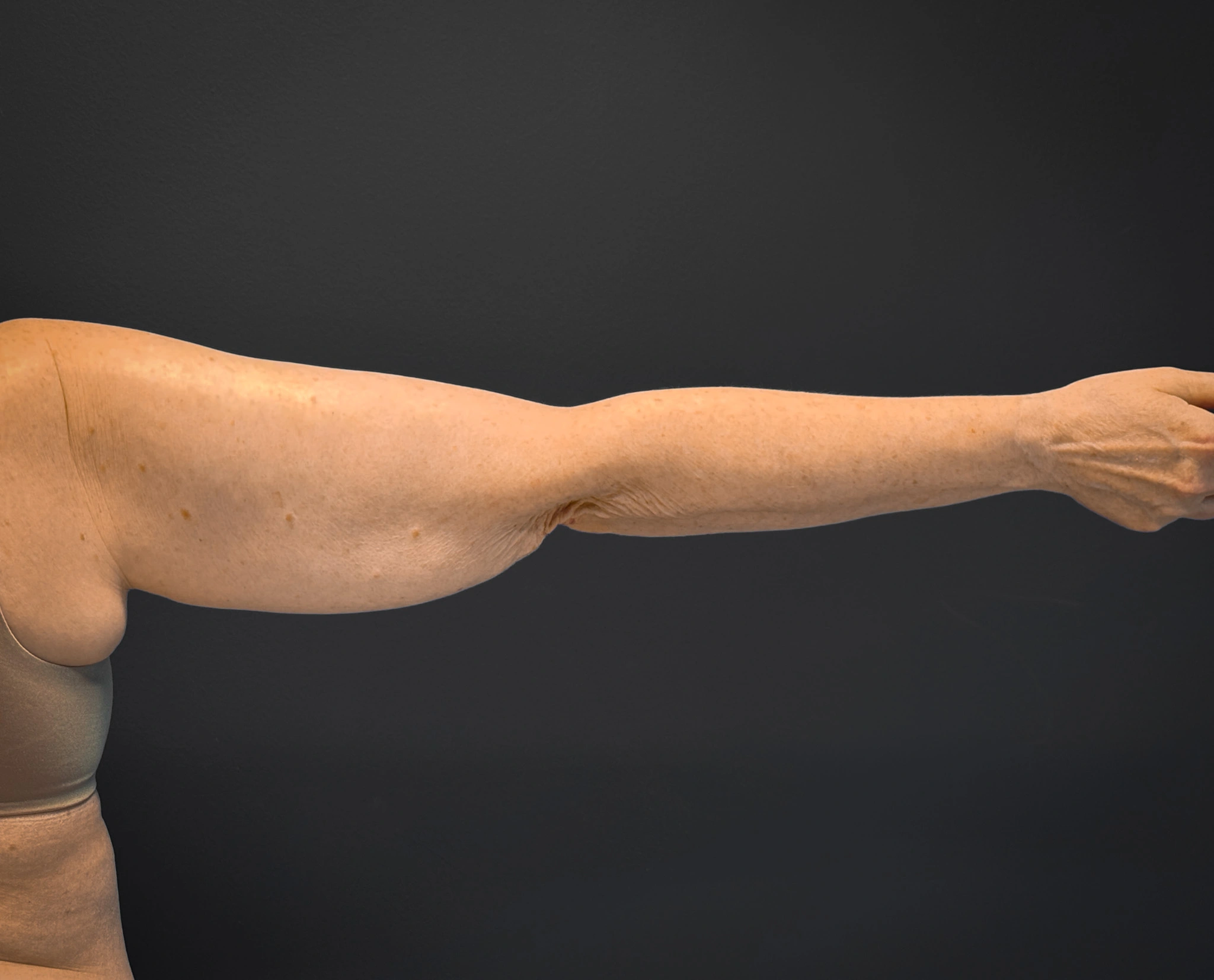 Brachioplasty-Case--3119 | Before Arm Lift 4