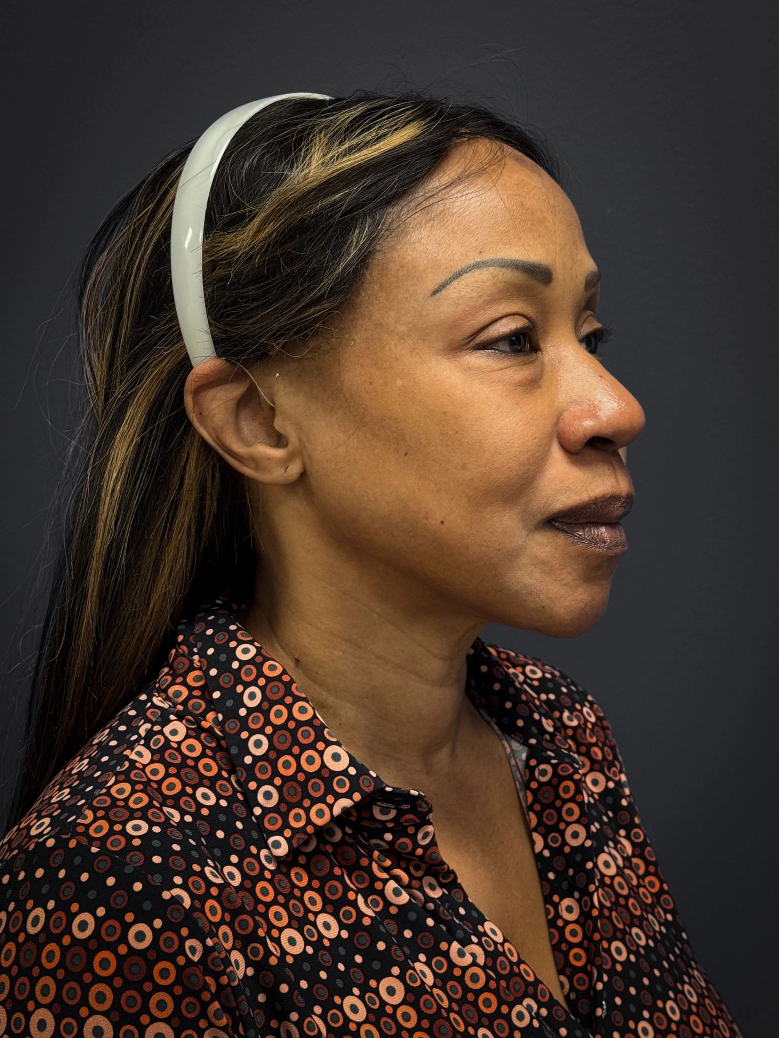 Facelift-Lower-Blepharoplasty-Case--6866 | Before Eyelid Surgery 6