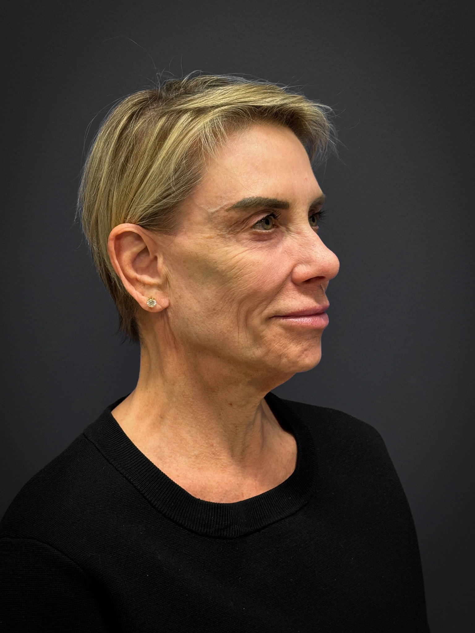 Facelift-Case--4219 | Before Facelift 3